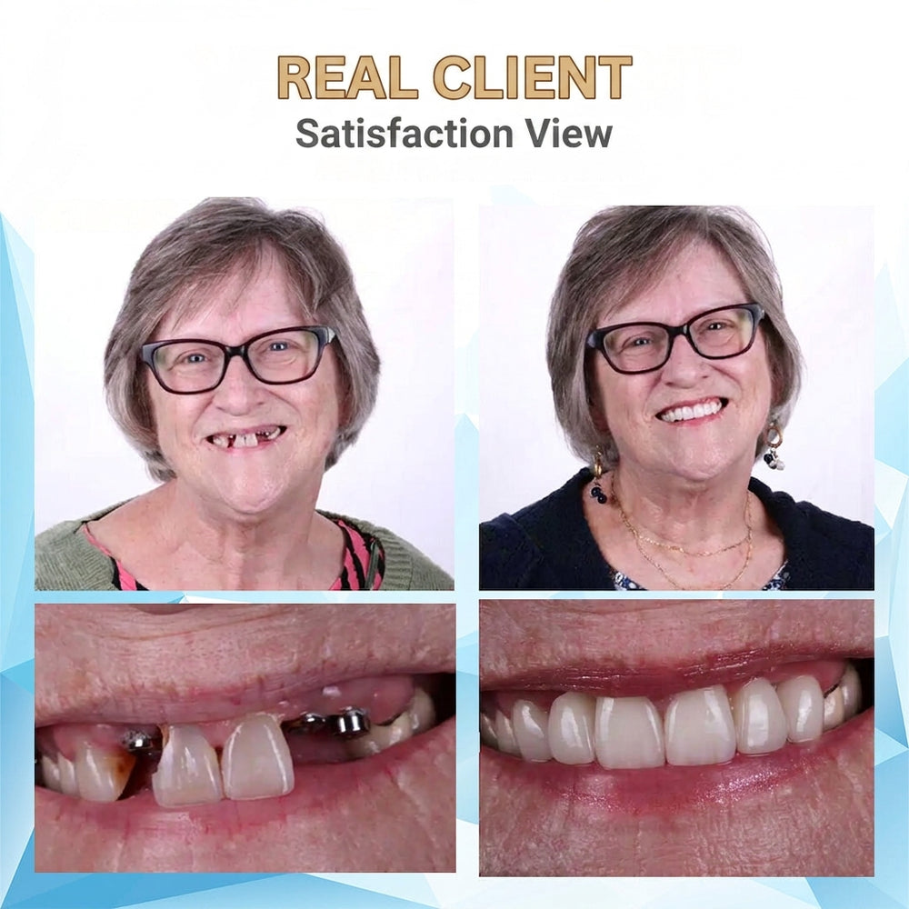 Snap-On Teeth Veneers - Upper and Lower Set with Moldable Fitting Beads, Reusable Silicone Cosmetic Dentures, White (5)